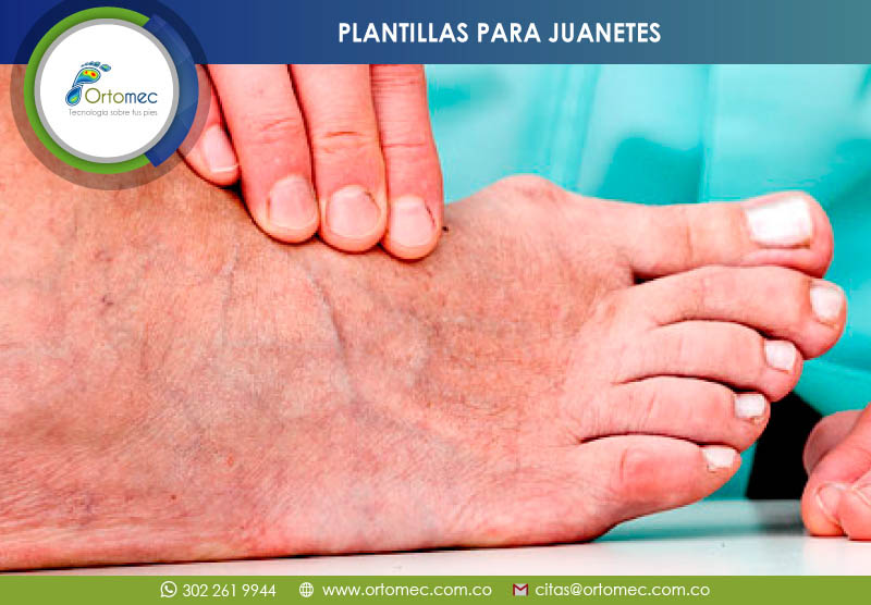 Plantillas para tratamiento Allux Valgus